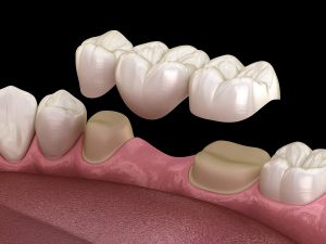 Dental Bridge Diagram